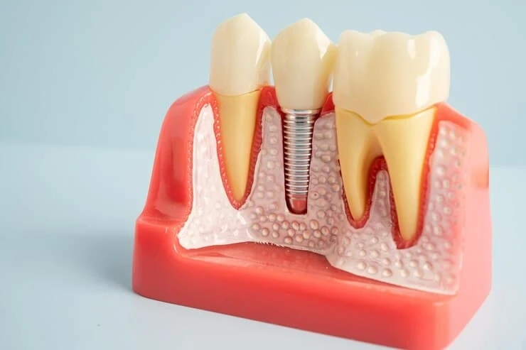 Benefits of Choosing Same Day Dental Implants in Derby