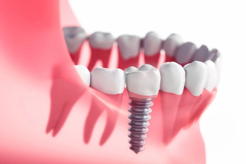 Everything You Need to Know About Dental Implants: Process, Benefits, and Recovery