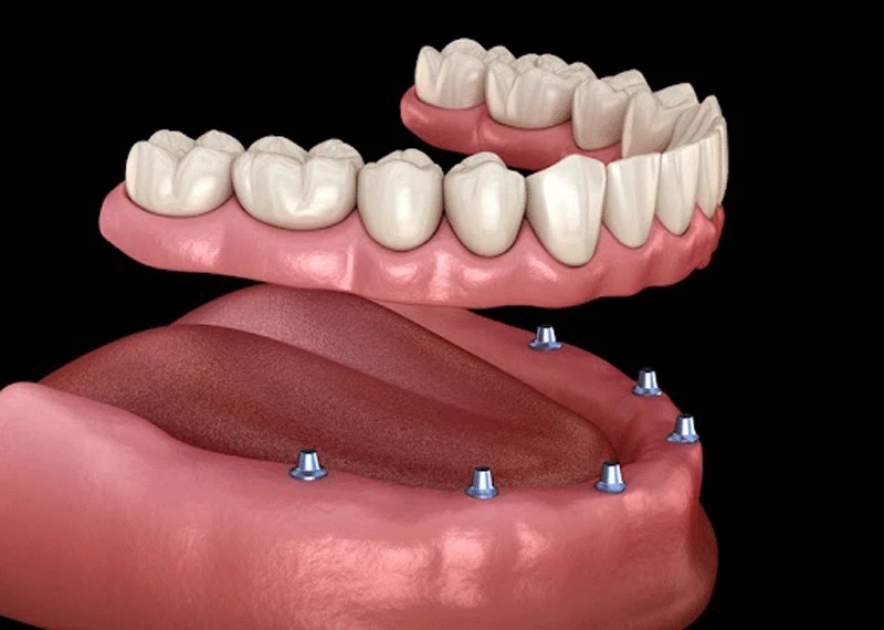 Affordable Options for Full Mouth Dental Implants in Dubai