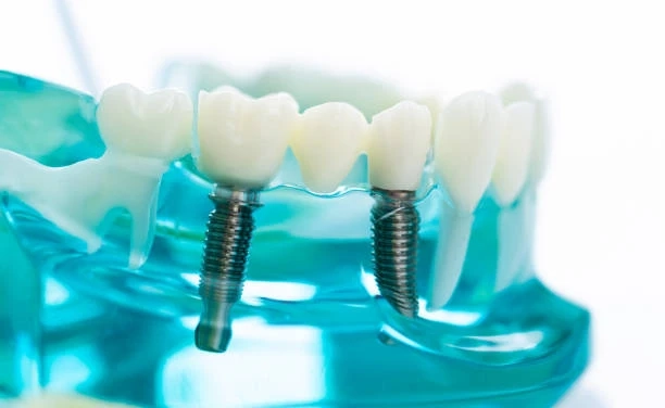 Long-Term Oral Health Benefits of Modern Dental Implants