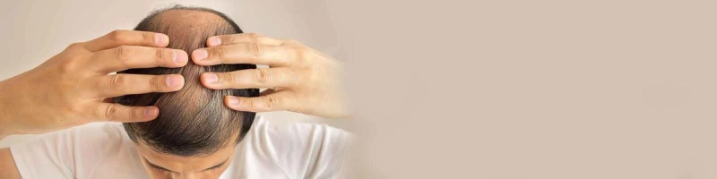 Stress and Hair Loss: Are They Related?