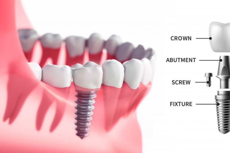 Unlocking the Secrets to Optimal Oral Health: A Guide to Dentistry in Campsie