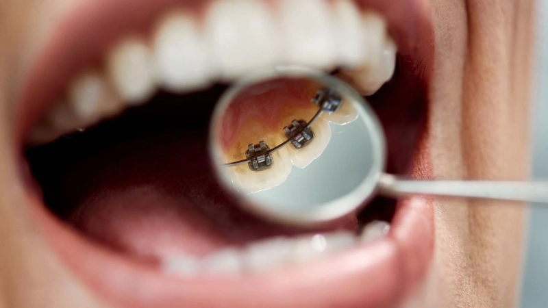 Want Straighter Teeth Without Visible Braces? Discover Lingual Braces in Garden Grove