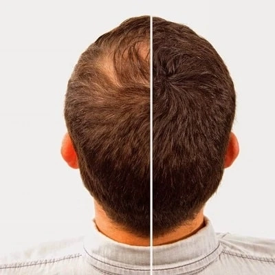 FUE vs. FUT Hair Transplant in Lahore - Advantages