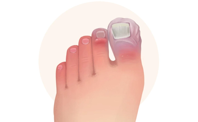 Chilblains: Cold Weather Woes