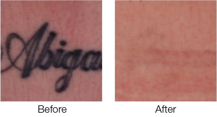 Latest PicoWay Technology used for Tattoo Removal NYC