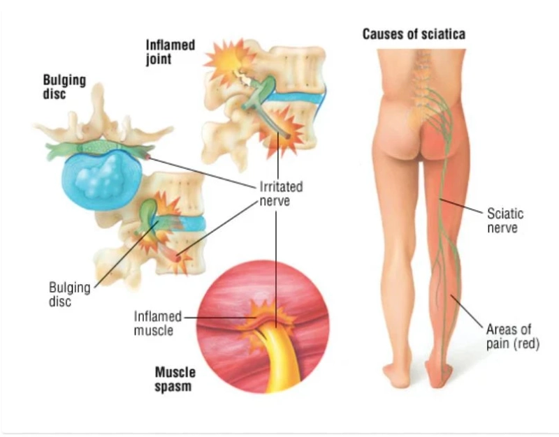 Alt du trenger å vite om isjias – årsaker, symptomer og behandling