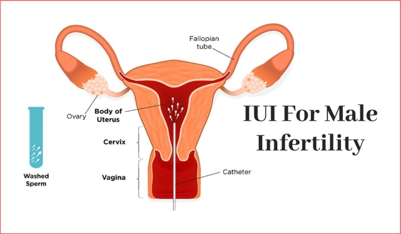 IUI for Male infertility: How is it Useful in Treating Male Infertility