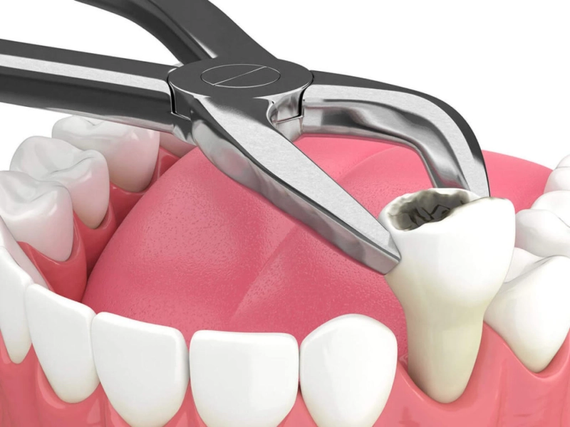 Wisdom Teeth Removal: Your Roadmap to a Smooth Recovery