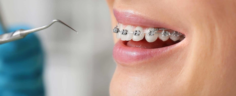 Braces Treatment for Adults: Age Limit, Cost & What to Expect