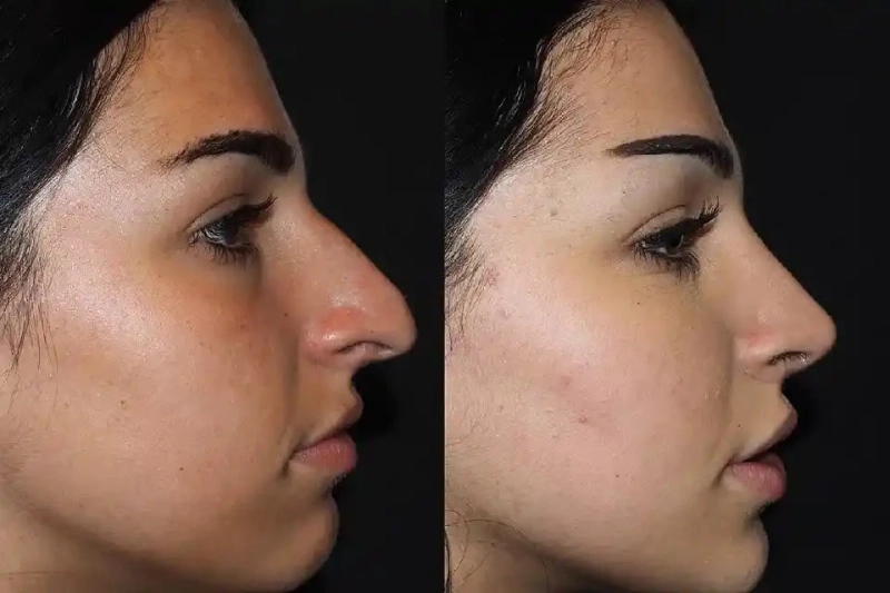 Traveling for Septoplasty: What to Consider When Coming to Dubai