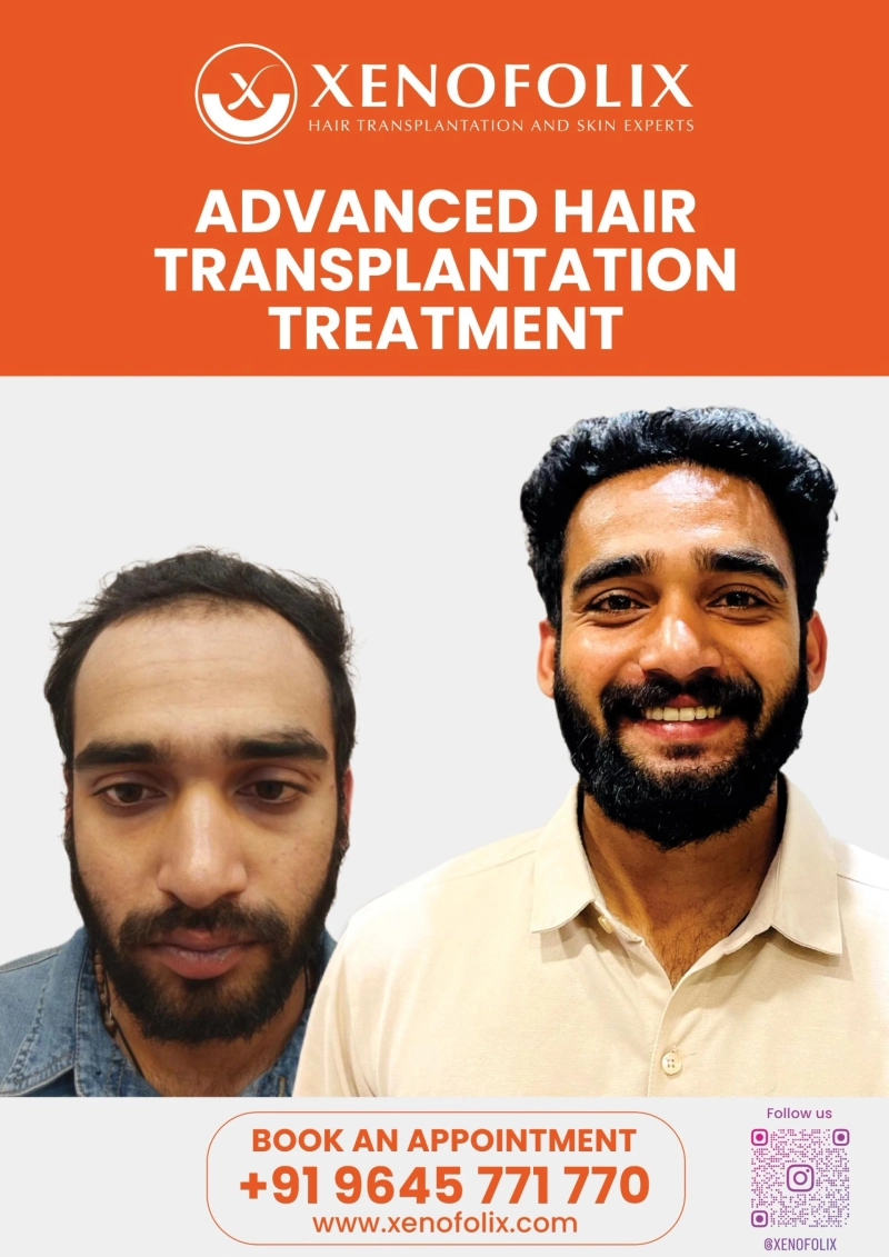 How to Choose the Right Hair Transplant Clinic in Kochi: A Doctor-Led, Safety-First Guide