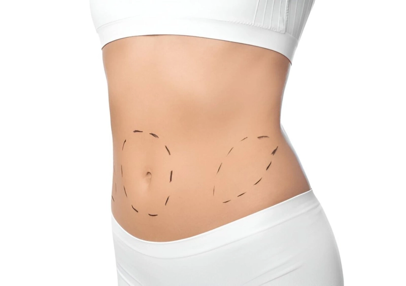 Tummy Tuck After Pregnancy: Getting Your Confidence Back