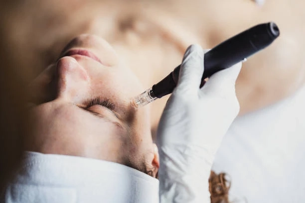 A Step-by-Step Guide to Your First Microneedling Session in Bristol