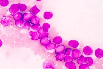 US Acute Myeloid Leukemia Market Expected to Reach 1 Billion US$ by 2028