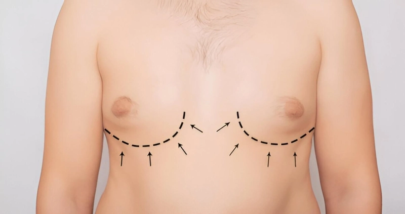Will Gynecomastia Surgery Leave Scars?