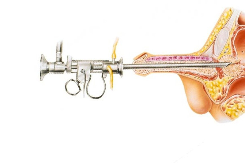 Seeking for Prostate Treatment Cost in Delhi With Surgical Removal of the Prostate Gland