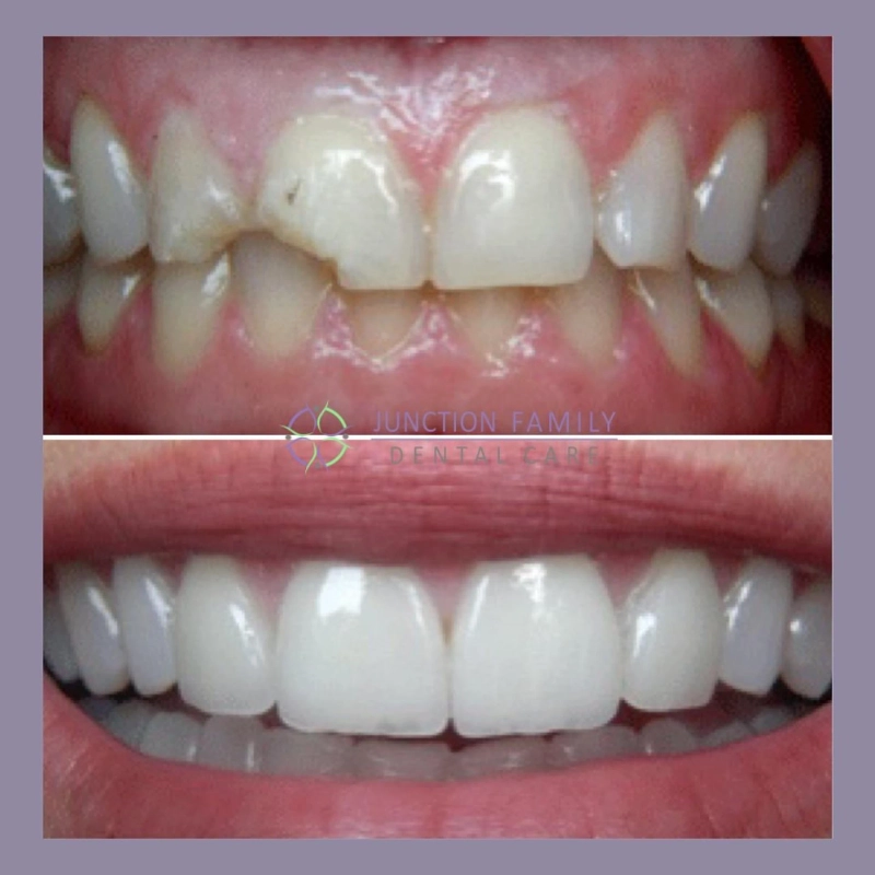 Transforming Your Smile With Painfree Conservative Ceramic Veneers