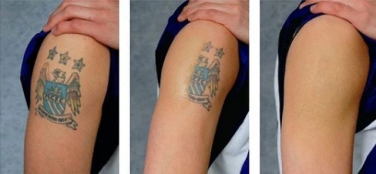 The right solution for Tattoo Removal NYC