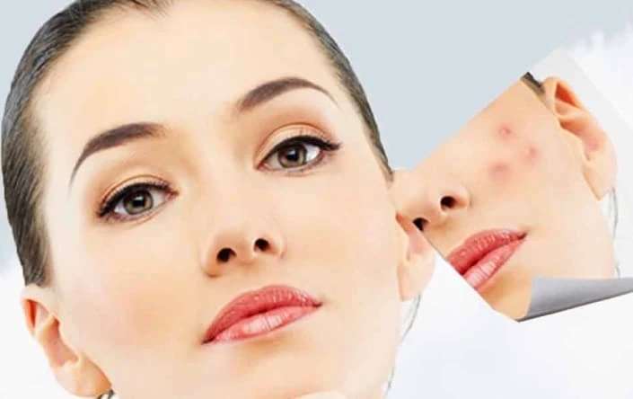 Treatment For Acne and Acne Scars With Chemical Peel