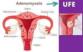 Managing Adenomyosis: Treatment Options and Lifestyle Strategies