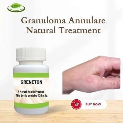 Treatments for Granuloma Annulare in the Year 2023