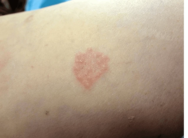 The Different Treatment Options for Granuloma Annulare