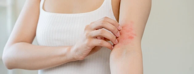 Eczema: Causes, Symptoms And Treatment Of Eczema