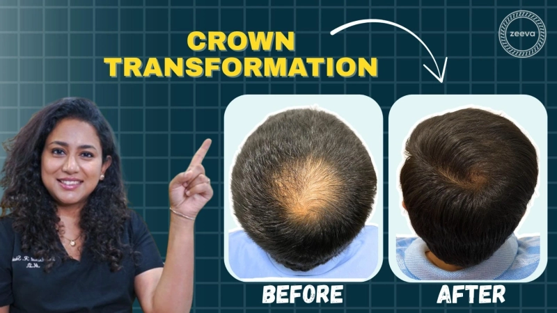 Hair Loss Treatment in Ahmedabad: A Complete Guide for Informed Decisions
