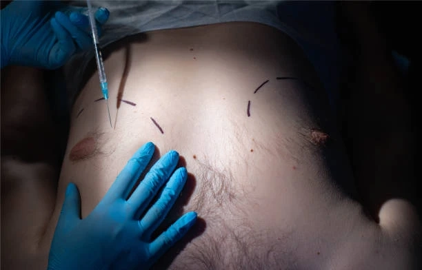 Sculpting Confidence: Inverted Nipple Surgery in Riyadh
