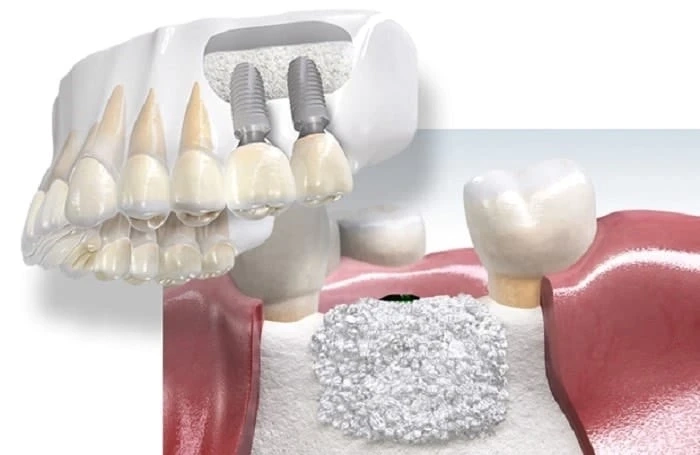 What Are Different Drilling Techniques in Implant Osteotomy?