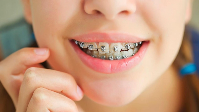 Smile Transformation with Braces: Real Benefits Beyond Looks