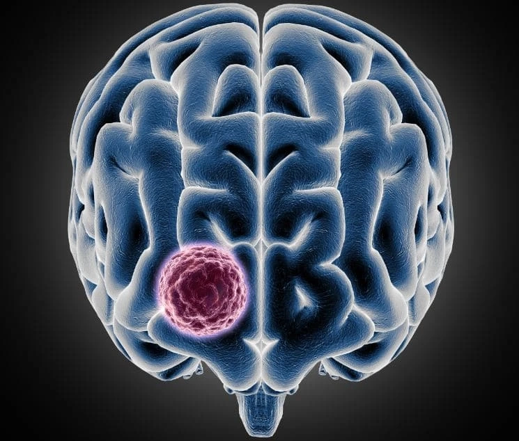 Brain Tumor Myth Busters | Specialty Care Clinics