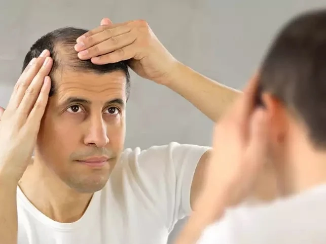 How is Hair Transplant Better Than Prosthetic Hair?