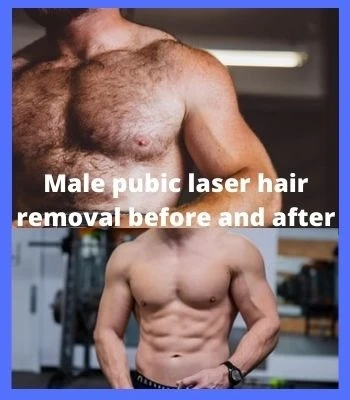 Male pubic laser hair removal before and after