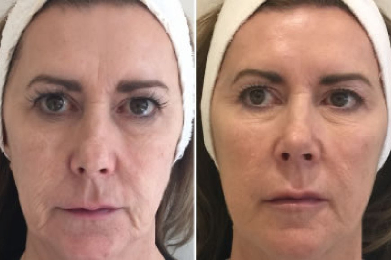 Revolutionizing Skin Rejuvenation Profhilo in Leeds