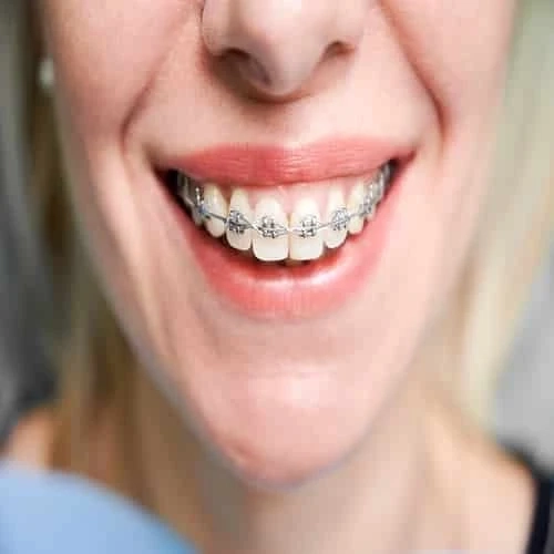 Understanding the Braces Timeline: How Long Do Braces Take?