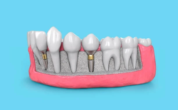 Why Dental Implants Are the Gold Standard for Tooth Replacement