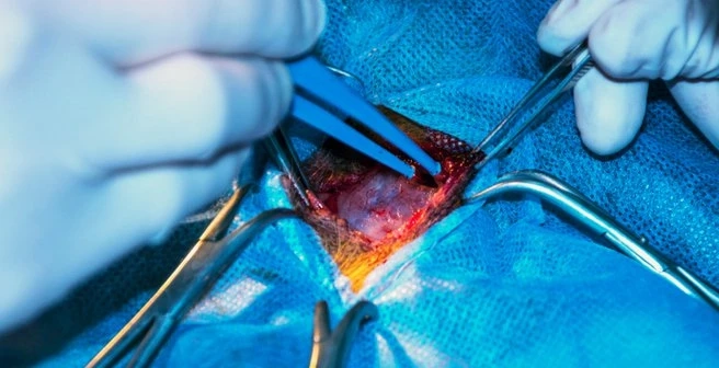 Electrosurgery Market Growth, Trends And Future Forecast 2023–2028