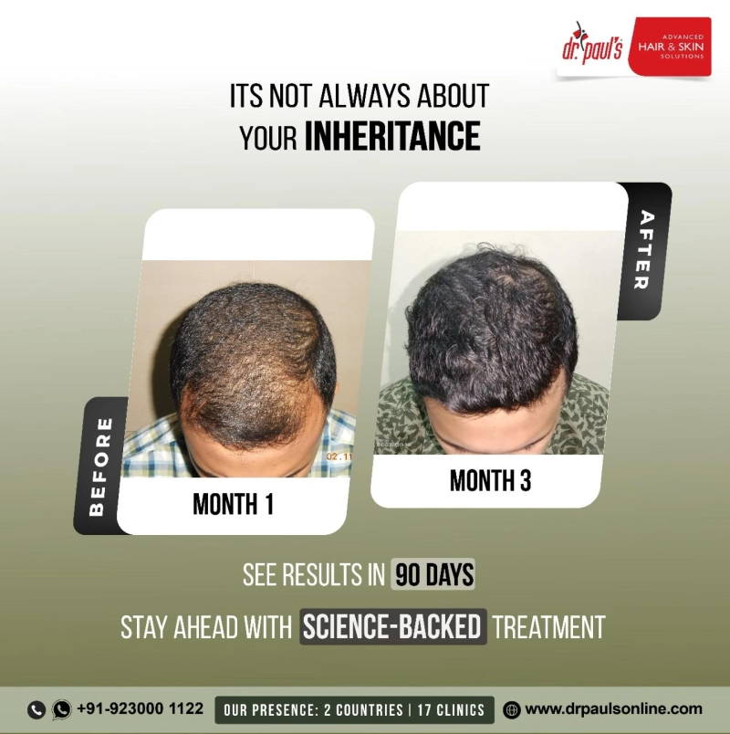 Understanding Hair Loss Treatment and Hair Transplant Cost in Kolkata
