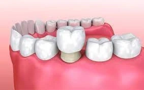 What are Benefits of Dental Crown?