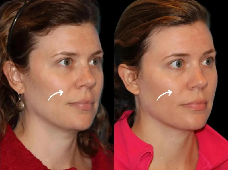 Sculptra Treatments in Dubai for Postpartum Care