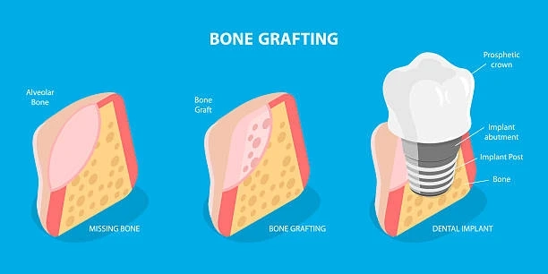 Dental Bone Grafting: What Patients Should Expect