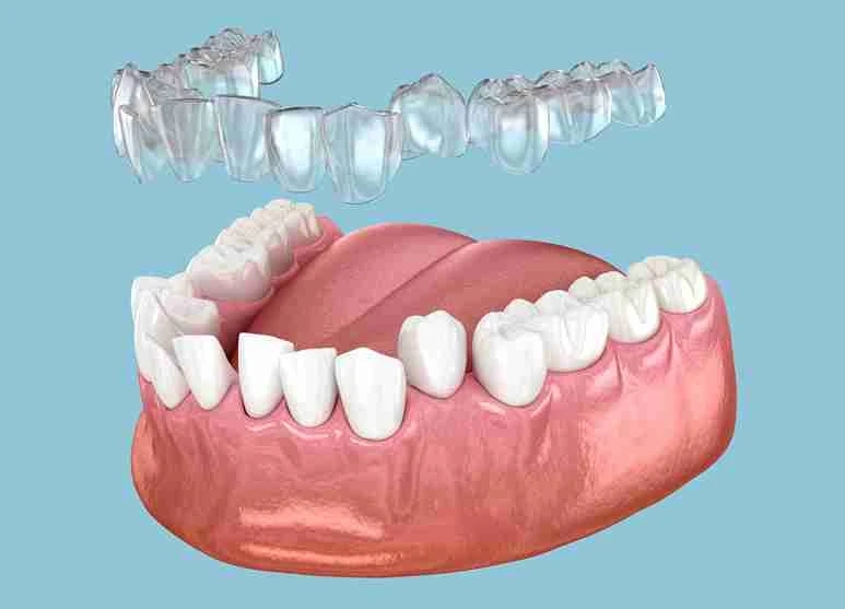 Dental Implant Benefits for Patients in South Shields