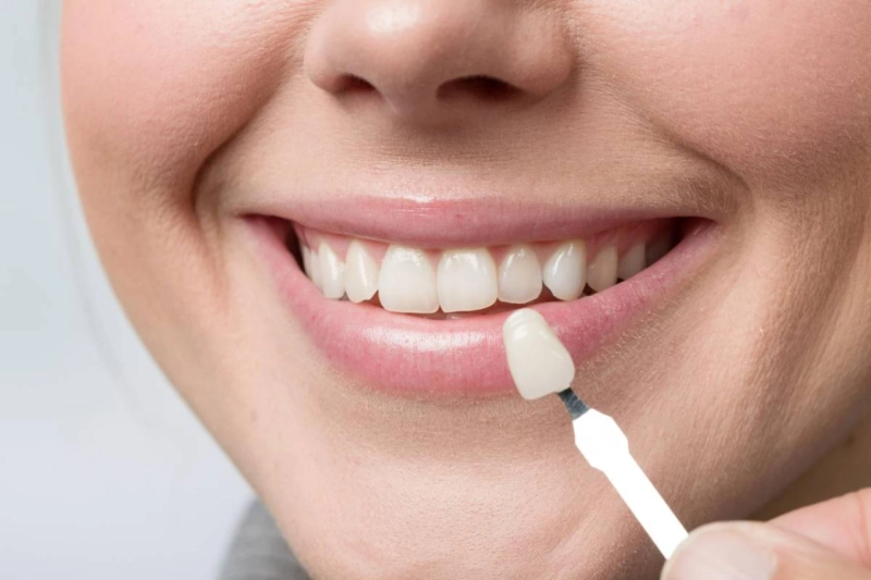 Exploring Veneers: A Guide to Transforming Your Smile