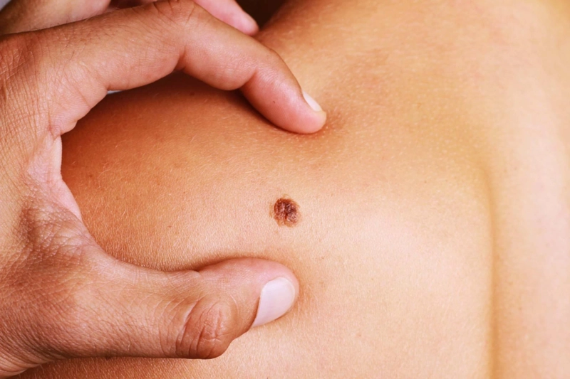 Australian Skin Cancer Clinic - Skin Check Sayyal Health Services