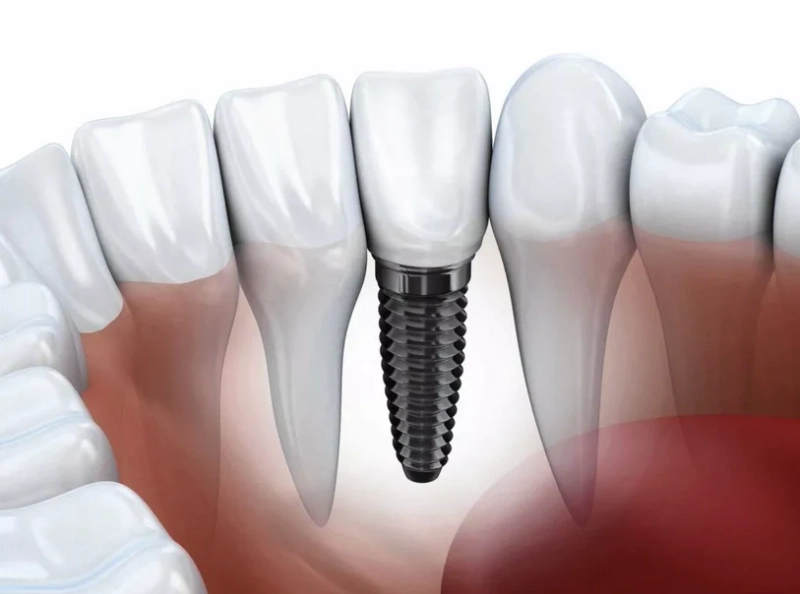 How the Best Dental Implants in San Diego can Enhance Your Smile