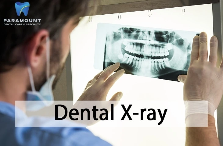 A Brief Insight Into Dental X Rays And Their Types