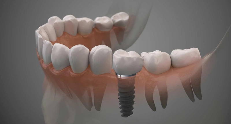 Implant Dentures in Reston, VA: A Complete Guide to Permanent Smiles