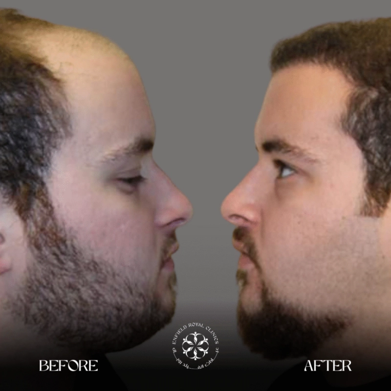 The Science-Driven Path to Permanent Hair Growth With Hair Transplant